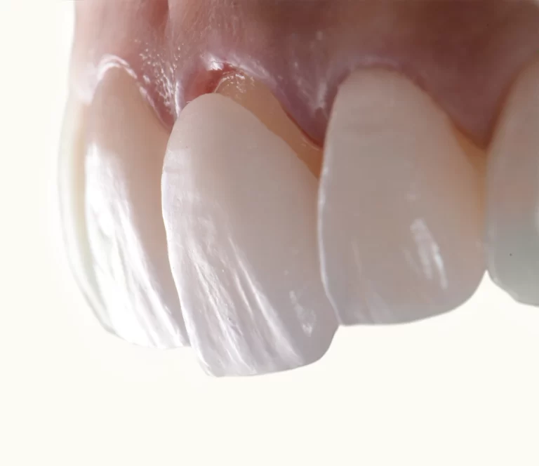 5 Things To Consider When Estimating Veneers Cost